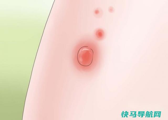 如何辨认葡萄球菌感染 第2张