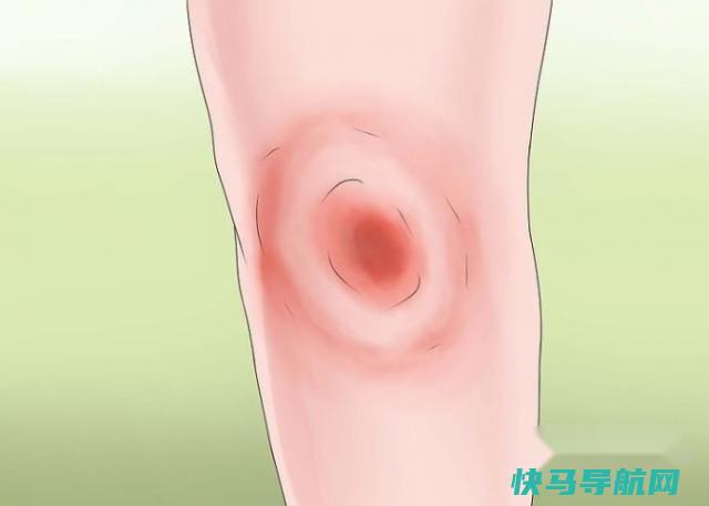 如何辨认葡萄球菌感染 第3张