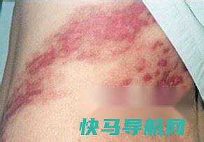 湿疹痒不能吃什么
